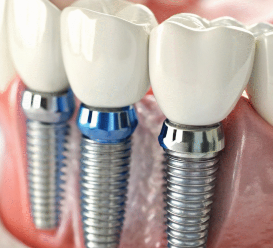 زراعة الأسنان