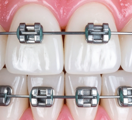 تقويم الأسنان