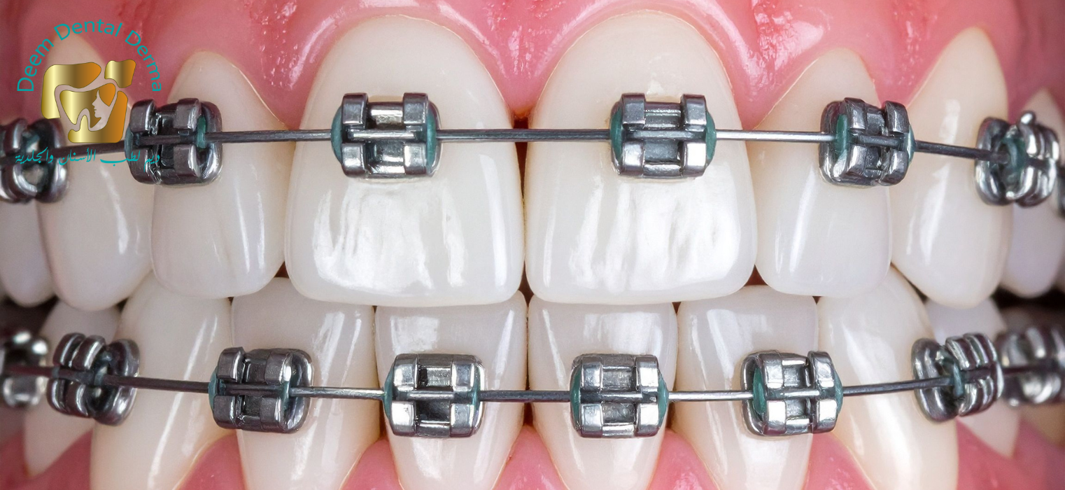 تقويم الأسنان