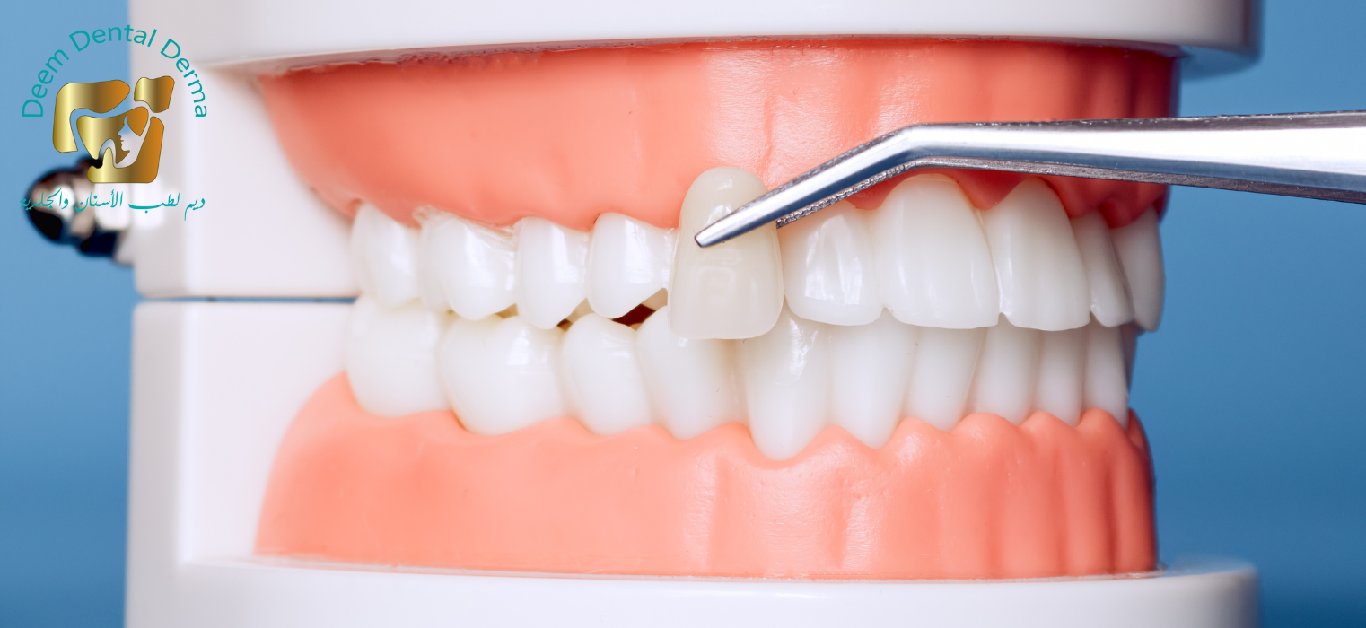 تركيبات وتلبيسات تجميلية