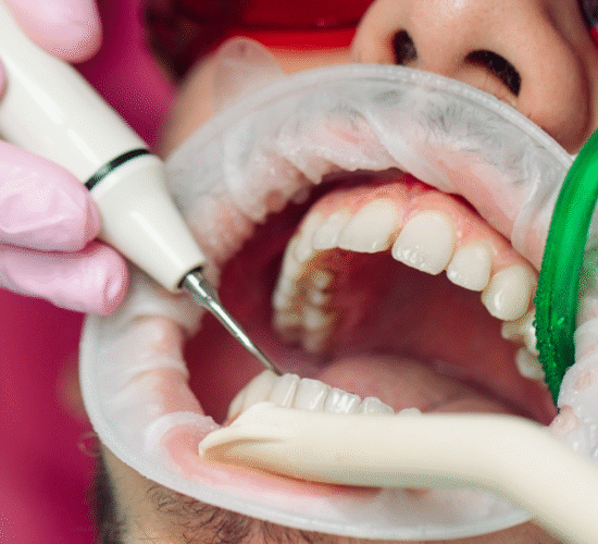 تنظيف وتلميع الأسنان