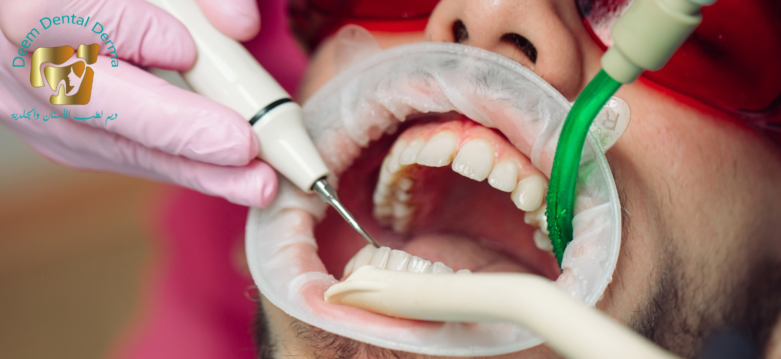 تنظيف وتلميع الأسنان