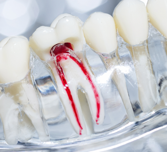 علاج العصب والحشوات التجميلية