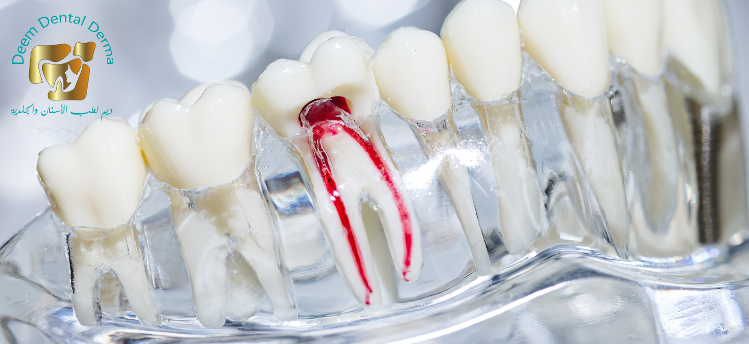 علاج العصب والحشوات التجميلية